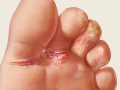 athletes foot infection