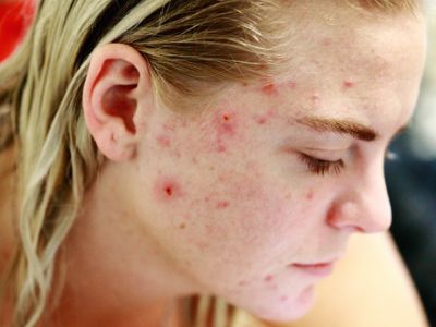 woman acne on face