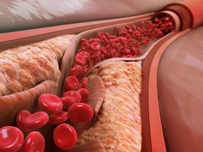 cholesterol in blood vessels of human