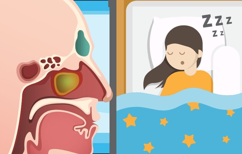 Can Rhinitis Affect Your Sleep?