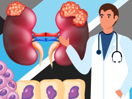 What is Kidney Cancer? Symptoms and Treatment