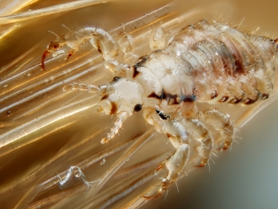 head lice on a girls hair under a microscope