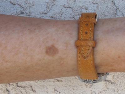 liver spot on a person wearing a brown leather watch