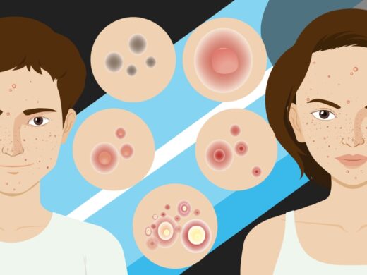 What is Acne Scarring? Causes and Treatment